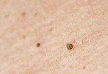 How to Treat Genital Warts