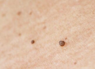 How to Treat Genital Warts